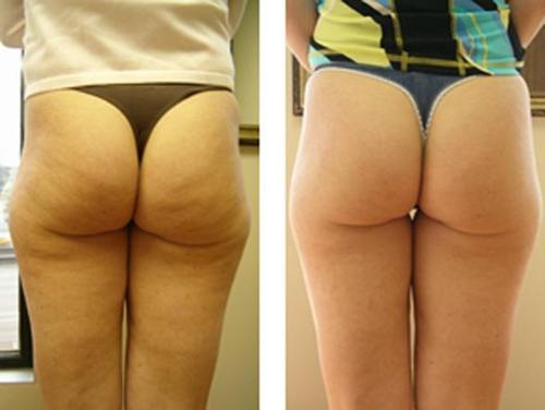 help-cellulite-thighs-5274